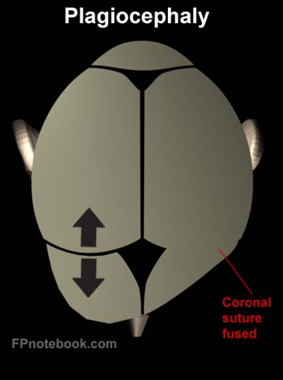 Plagiocephaly