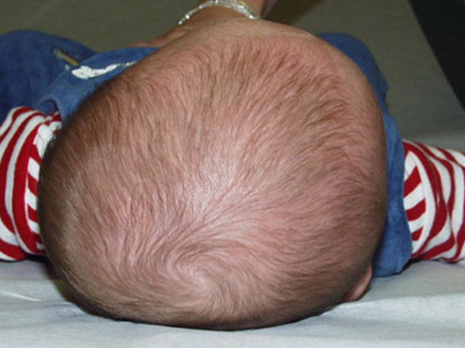 Plagiocephaly