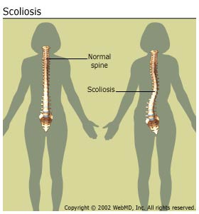 Scoliosis